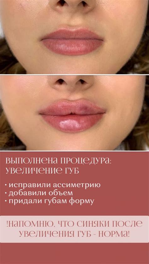 Увеличение губ | Косметология | Косметолог | Губы эстетика | Ботокс ...