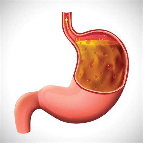 gastroesophageal reflux disease illustration for medical and