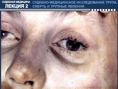 Судебно-медицинское исследование трупа. Смерть и трупные явления ...