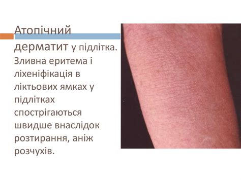 Атопічний дерматит - презентация онлайн