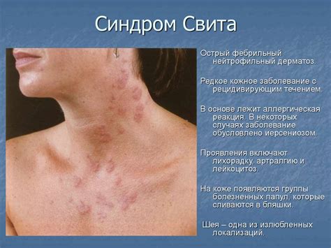 Дифференциальная диагностика высыпаний на лице - презентация онлайн