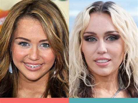 Orthodontics Australia | 6 Celebrities With Braces Before and After ...