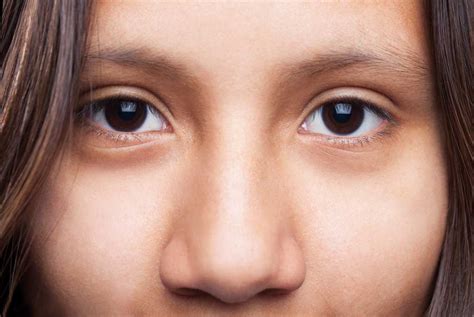 Anisocoria (Pupil Besar Sebelah): Gejala, Penyebab, Pengobatan, dll