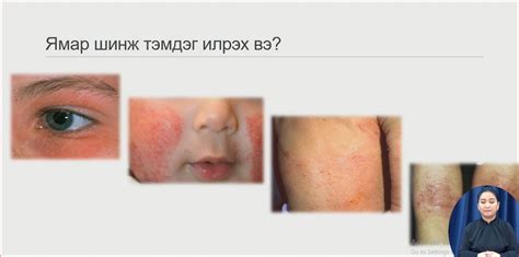 Ц.Уранчимэг: Чонон хөрвөс өвчний нэг онцлог нь тууралт маш богино ...