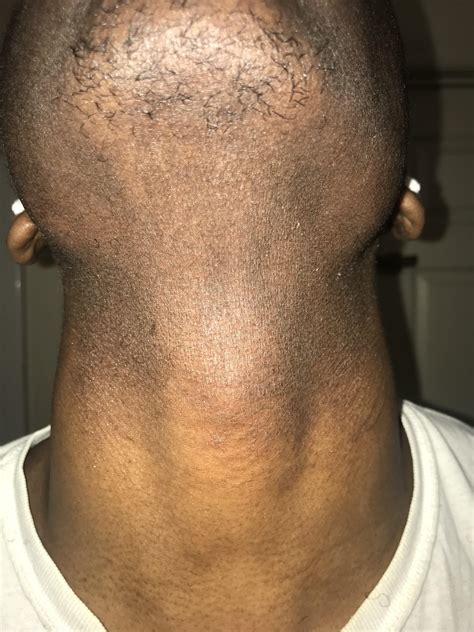 Signs of a rash? My neck has been feeling dry and itchy since the start