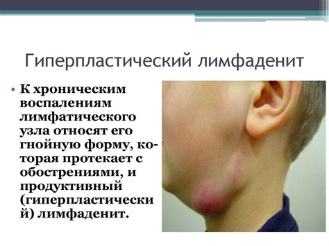 Лимфаденит - презентация онлайн