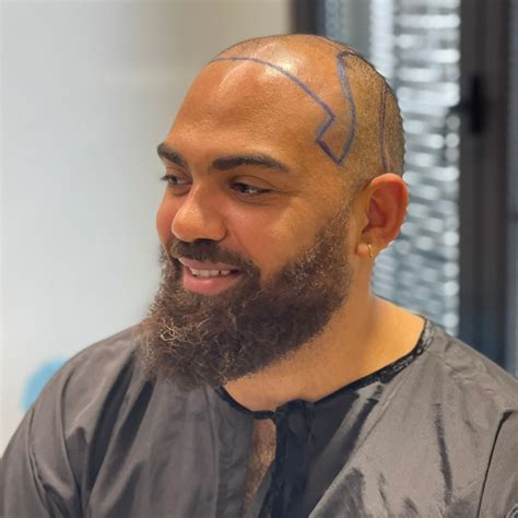 hair transplant  shaved head