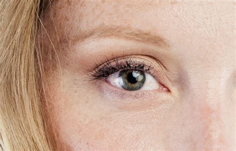 Drooping Eyelids