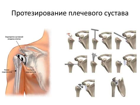 Переломы плечевой кости - презентация онлайн