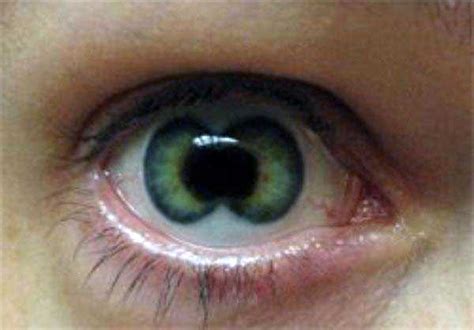 Seriously Messed Up Human Eyes | KLYKER.COM
