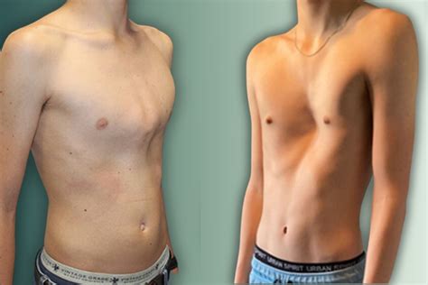 Can You Live A Normal Life With Pectus Excavatum at Sheila Tejada blog