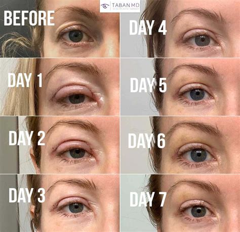 What is blepharoplasty, the cosmetic surgery procedure loved by