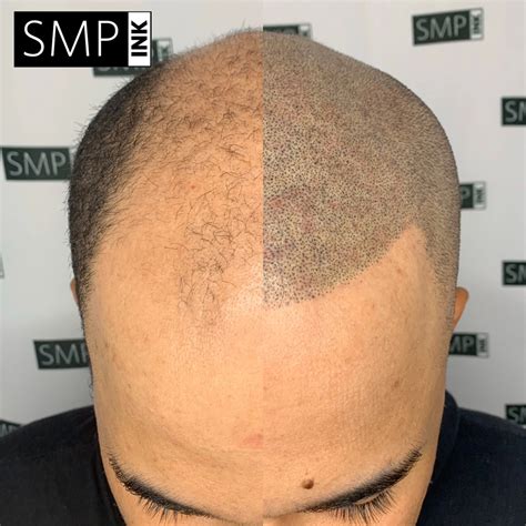 Scalp... - Миноксидил от Михи Бороды / 1minoxidil.ru