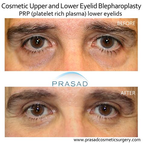 Laser Treatment for Dark Circles Under Eyes | Dr. Prasad Blog