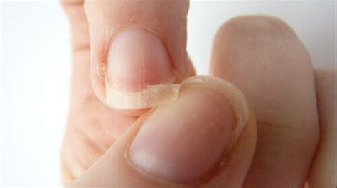 Uñas Quebradizas : Remedios Naturales - Conecta Salud