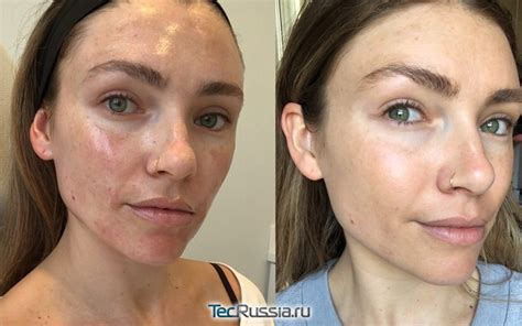 Co je to jednoduchými slovy Microneedling?