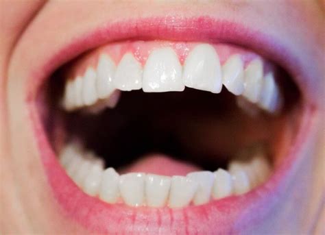 Different Types of Teeth | Incisors, Molars, Canines & More