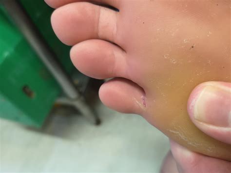 Skin underneath my pinky toe has split revealing the fleshy bit