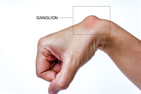 Ganglion - causes, treatment