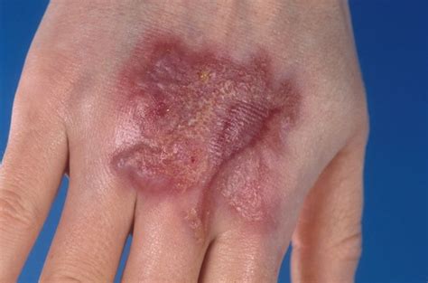 Wound Care Pyoderma Gangrenosum at Jennifer Hooper blog
