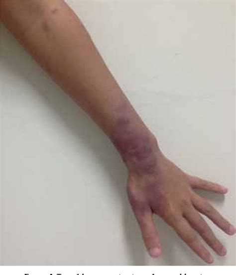 Borderline leprosy | Semantic Scholar