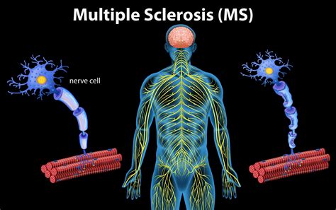 MS related symptoms and Manual osteopathy- Best Osteopathy