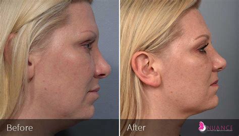 Neck Lift Surgery Las Vegas, NV | Plastic Surgeon in Las Vegas, NV