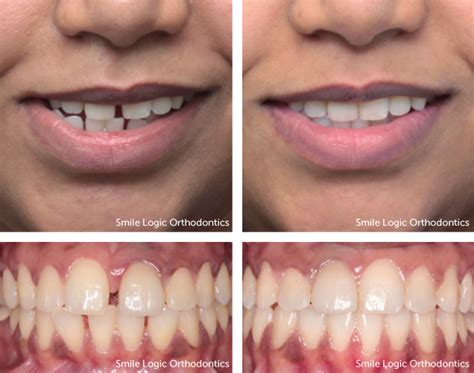 Spaced Teeth Before And After - Get Images