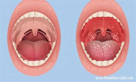 how to know if your tonsils are swollen