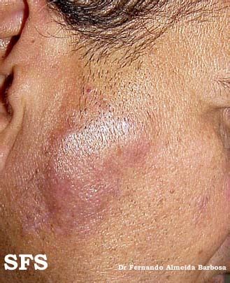 Borrelial Lymphocytoma On Cheek