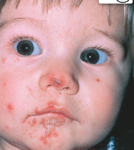 Chapter 23 Nursing Care of the Child With an Alteration in Tissue ...