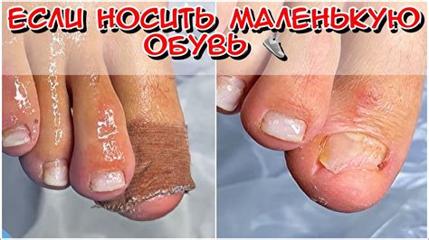 Что будет если носить маленькую обувь / Что с ногтем? Грибок ногтей ...
