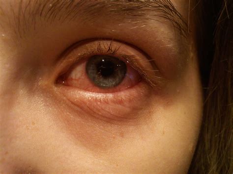 File:An eye with conjunctivitis.jpg