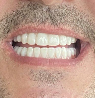 JAX DENTAL IMPLANTS & DENTURES - Updated January 2025 - 23 Photos & 14 ...