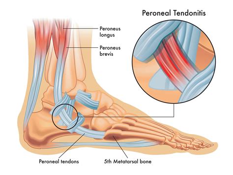 Sports Podiatry's Role in Peroneal Tendonitis Treatment