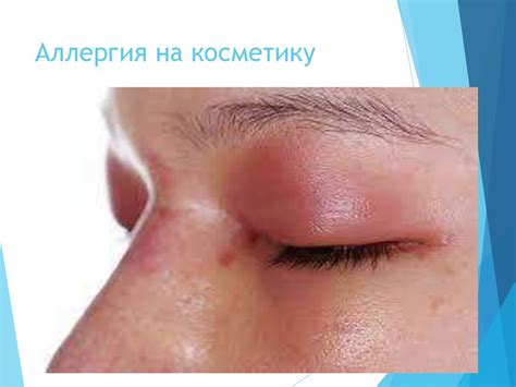 Заболевания век - online presentation