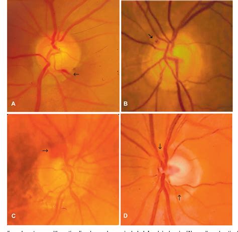 Figure 1 from Optic disc hemorrhages in glaucoma and common clinical ...