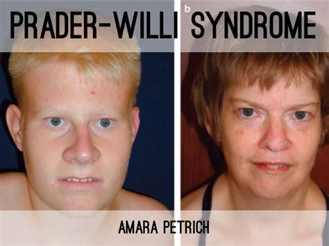 The Prader Willi Syndrome Pws Is A
