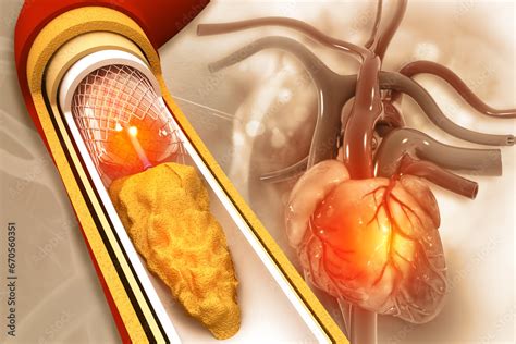 stent  balloon angioplasty  illustration stock illustration