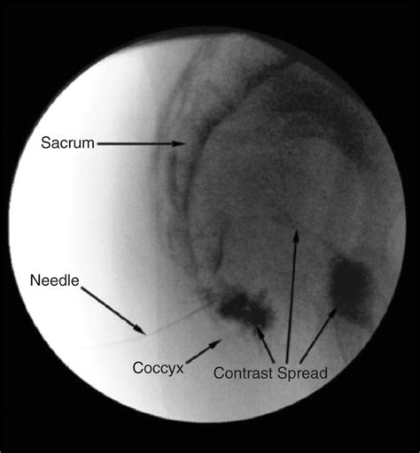 Ganglion Impar Block | Anesthesia Key