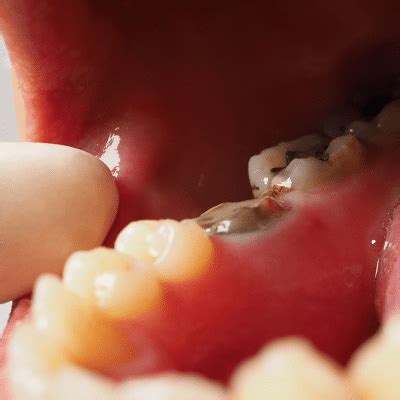 tooth decay pictures