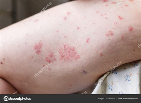 Allergische uitslag dermatitis eczeem-huid op been van patiënt ...