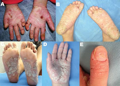 Psoriasis On Hands And Feet