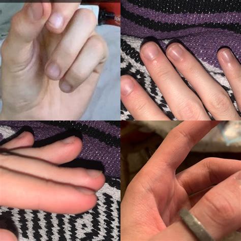 Need help. Fingers swelling, veins darkening! : r/DMT