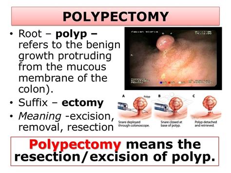 colonoscopy  polypectomy