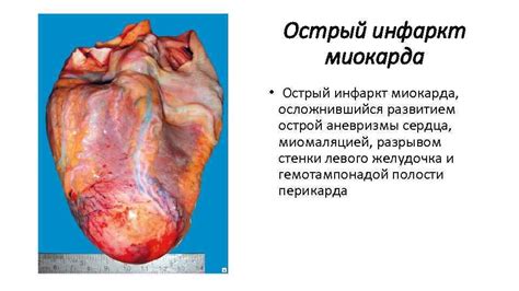 Ишемическая болезнь Макропрепараты Инфаркт миокарда 1