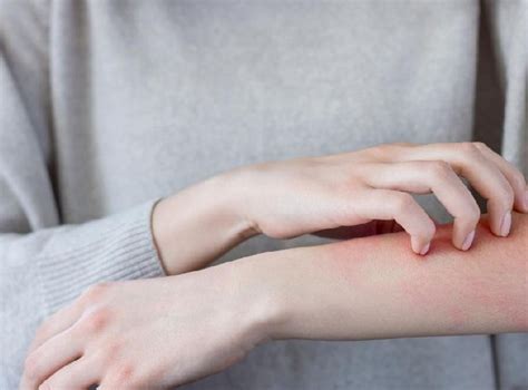 tips menghilangkan ruam  tepat tuturasa