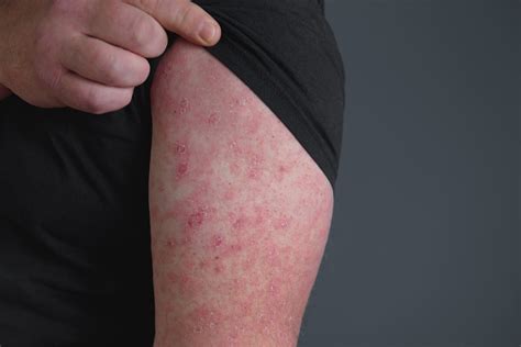 Erysipel: aké sú príčiny vzniku kožnej infekcie? + Príznaky a liečba ...