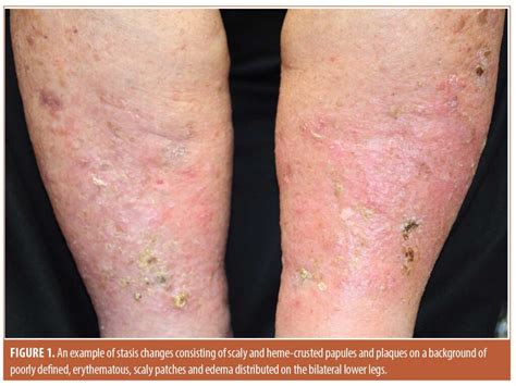 Stasis Dermatitis: Pathophysiology, Current Treatment Paradigms, and ...