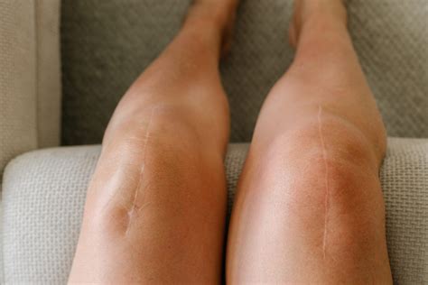 If You Have This Symptom, It's Officially Time for a Knee Replacement